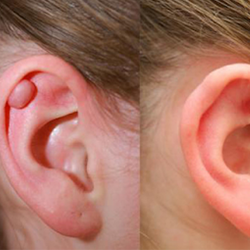 Keloid removal surgery treatment Near Avinashi Road, for scar-free and smooth skin results.